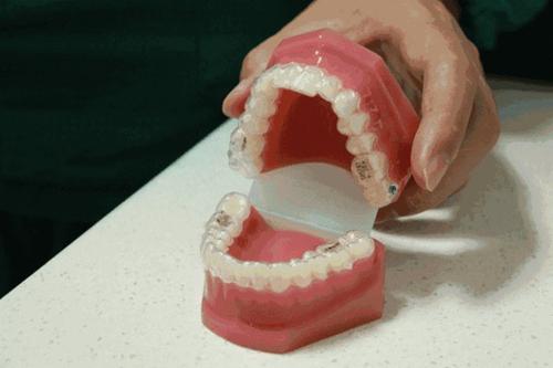 成人牙齿矫正要多久，可丽尔博士告诉你